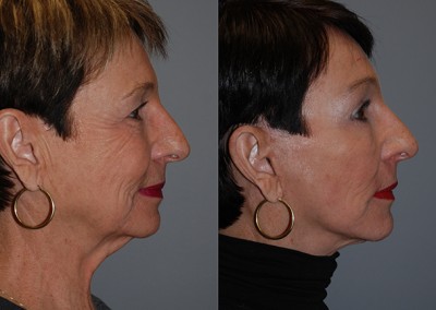 Youthful appearance renewed: Transformation through fat grafting