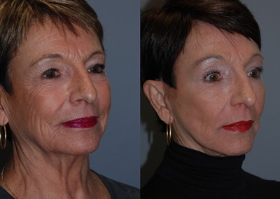 Natural-looking rejuvenation: Before and after fat grafting comparison