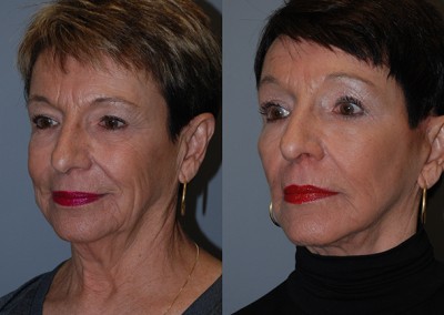 Facial harmony restored: Fat grafting results showcased