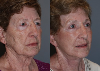 Rejuvenated facial contours: Before and after fat grafting progression