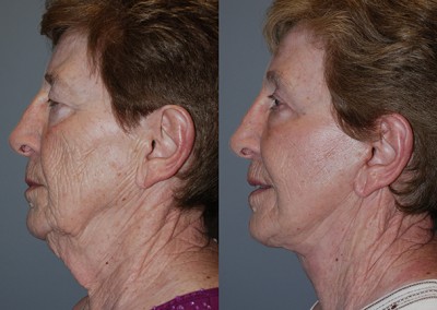 Facial rejuvenation journey: Before and after fat grafting comparison