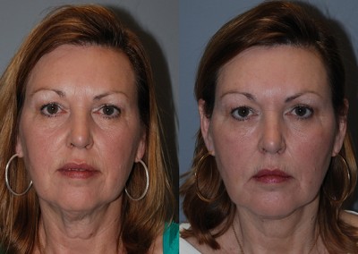 Radiant skin rejuvenation: Transformation through facial fat grafting