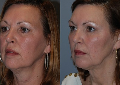 Age-defying transformation: Facial fat grafting outcomes showcased