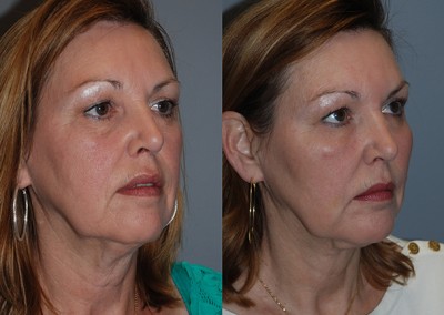 Rejuvenated facial features: Progression of fat grafting results