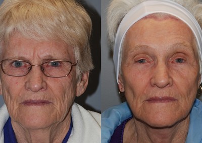 Revitalized appearance: Transformation through facial fat grafting