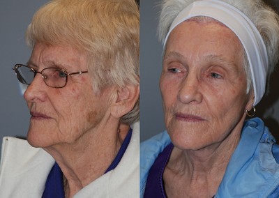 Facial contouring journey: Before vs after fat grafting images