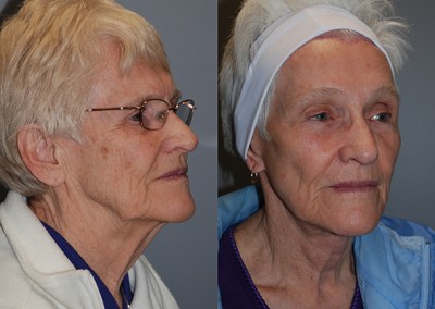 Youthful radiance restored: Comparison of facial fat grafting results