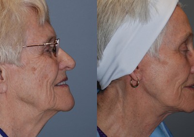 Enhanced natural beauty: Before and after fat grafting comparison