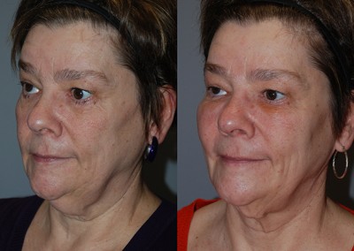 Balanced facial symmetry: Fat grafting transformation