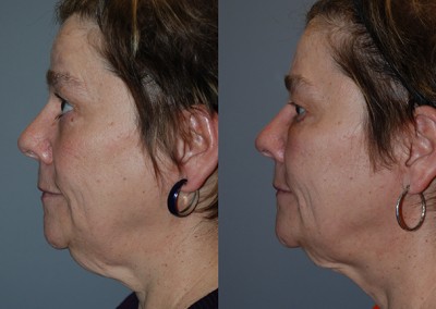 Youthful glow renewed: Before and after fat grafting progression