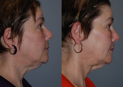 Facial rejuvenation journey: Fat grafting outcomes illustrated