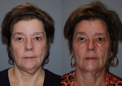 Harmonized facial features: Before vs after fat grafting photos