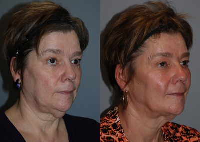 Enhanced facial fullness: Before and after fat grafting comparison