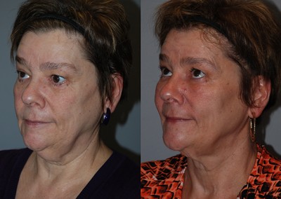 Radiant facial rejuvenation: Fat grafting results showcased