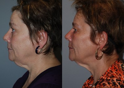 Youthful vibrancy restored: Before vs after fat grafting images