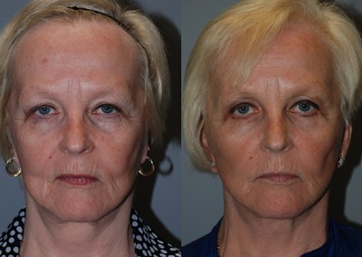 Refreshed facial contours: Progression of fat grafting results on full face