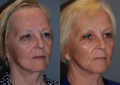 Facial volumization journey: Transformation through full-face fat grafting