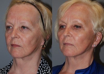 Restored facial fullness: Before and after full-face fat grafting photos
