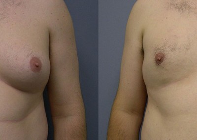 Before and After Male Breast Surgery: Comparative images highlighting the transformation of male chest contours