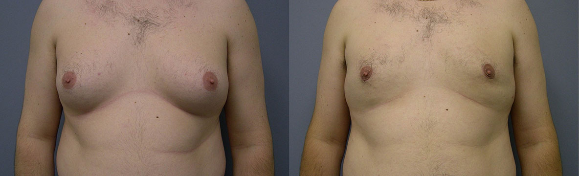 Before and After Male Breast Surgery: Comparative images highlighting the transformation of male chest contours