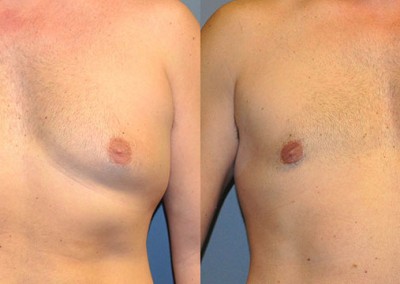 Before and After Male Chest Sculpting: Transformative images showing the refinement of chest contours