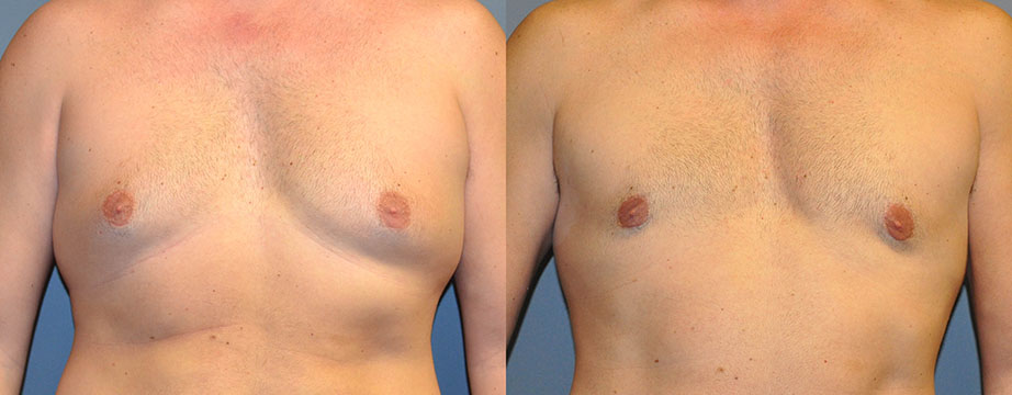 Before and After Male Chest Sculpting: Transformative images showing the refinement of chest contours
