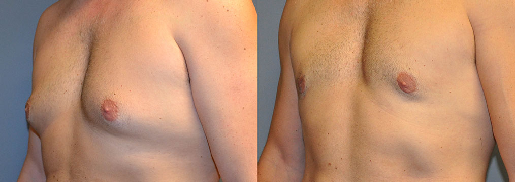 Gynecomastia Surgery Results: Visual evidence of successful male breast reduction treatment