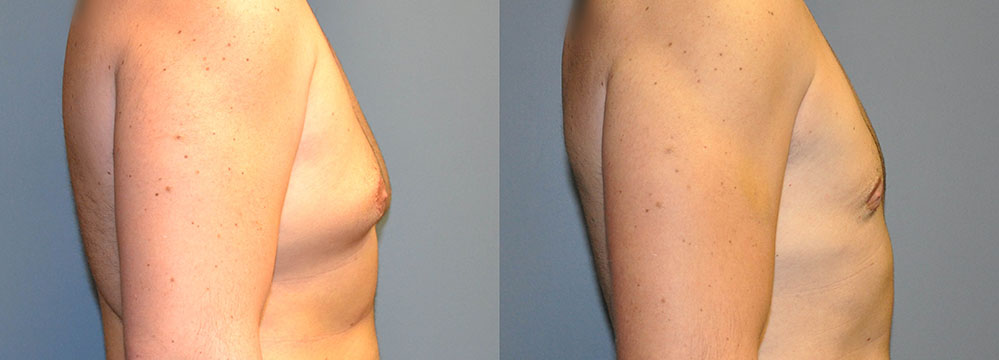 Male Chest Rejuvenation: Comparative snapshots depicting the improvement in chest appearance