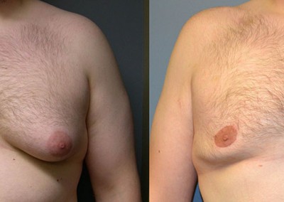 Gynecomastia Correction Journey: Before-and-after images showcasing the resolution of male breast enlargement