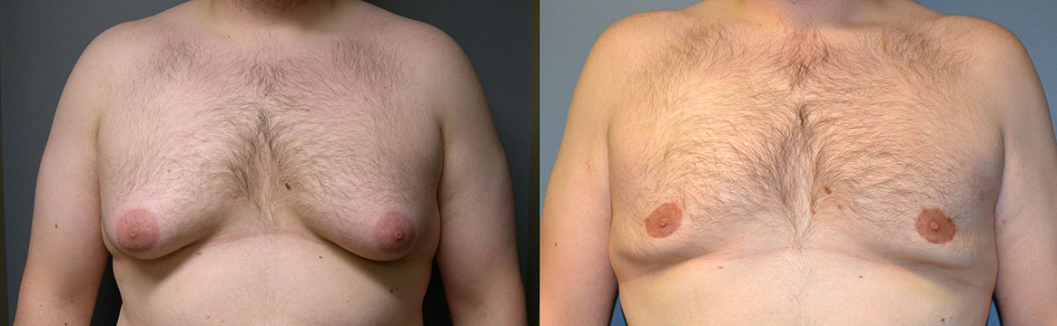 Gynecomastia Correction Journey: Before-and-after images showcasing the resolution of male breast enlargement