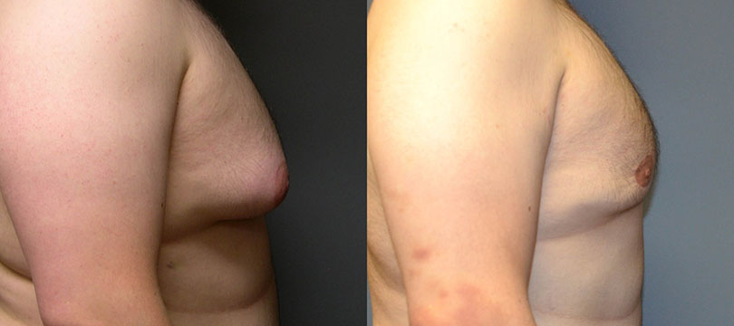 Male Breast Reshaping: Transformational photos illustrating the outcomes of gynecomastia surgery