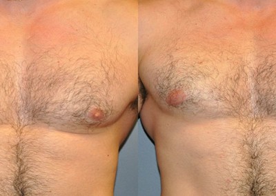 Gynecomastia Treatment Outcome: Comparative images displaying the reduction of male breast tissue