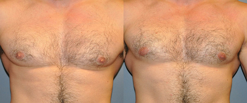 Gynecomastia Treatment Outcome: Comparative images displaying the reduction of male breast tissue