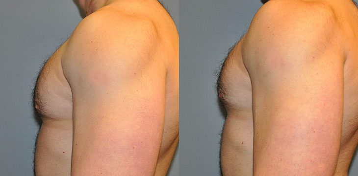 Male Breast Reduction Progress: Sequential photos documenting the results of gynecomastia treatment