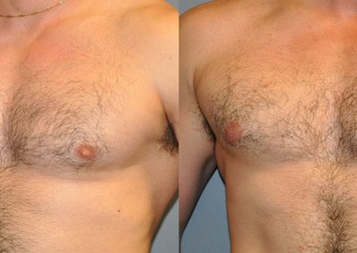Gynecomastia Surgery Success: Before-and-after snapshots demonstrating improved chest appearance
