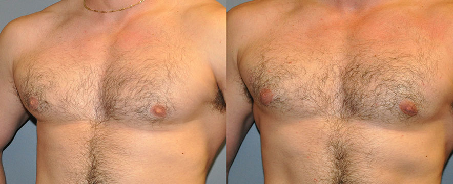 Gynecomastia Surgery Success: Before-and-after snapshots demonstrating improved chest appearance