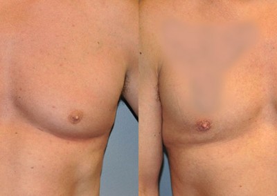 Before and After Male Breast Reduction: Transformative images of gynecomastia correction