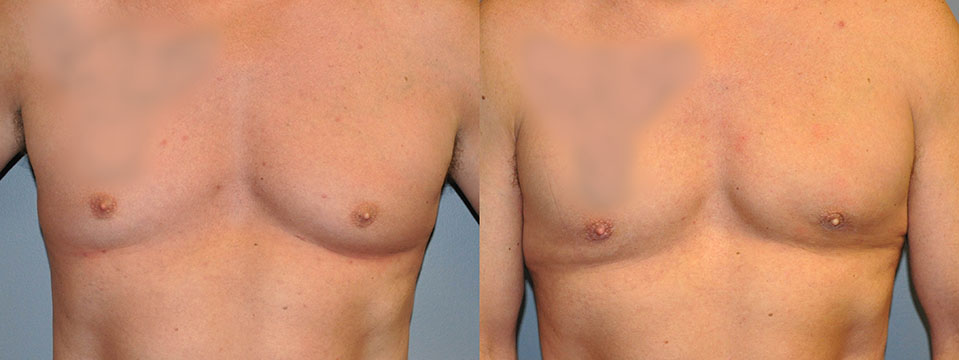 Before and After Male Breast Reduction: Transformative images of gynecomastia correction