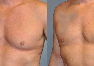 Male Chest Contouring: Visual evidence of the effectiveness of gynecomastia surgery