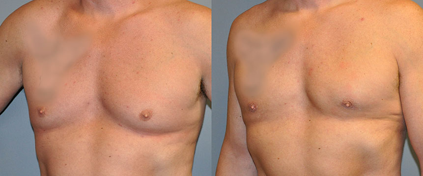 Male Chest Contouring: Visual evidence of the effectiveness of gynecomastia surgery