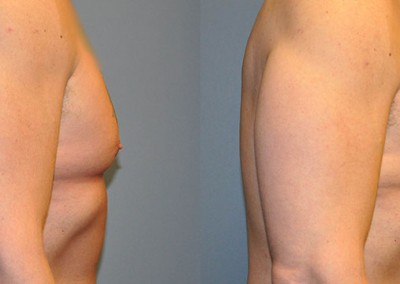 Gynecomastia Correction: Comparative photos showing male breast reduction outcomes