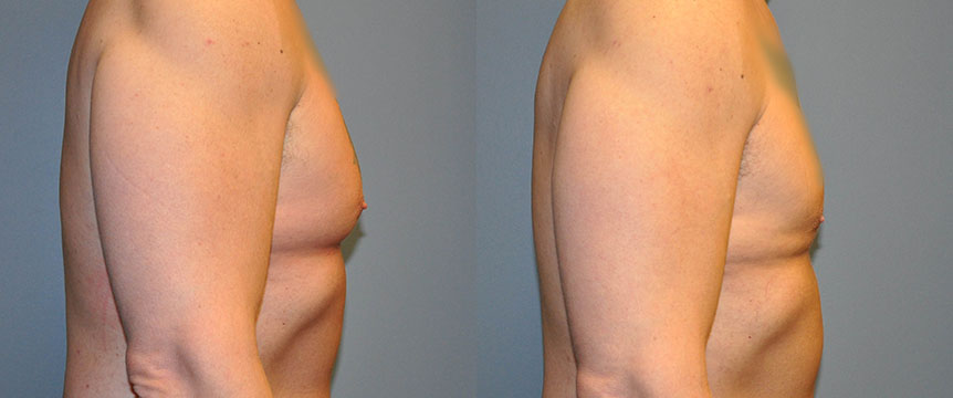 Gynecomastia Correction: Comparative photos showing male breast reduction outcomes