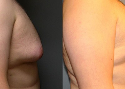 Male Chest Transformation: Before and after images of gynecomastia treatment results