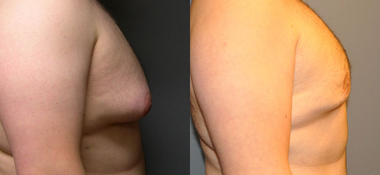 Male Chest Transformation: Before and after images of gynecomastia treatment results