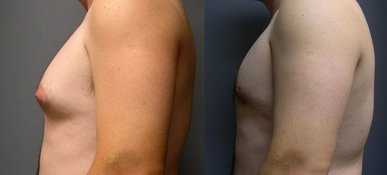 Gynecomastia Treatment Success: Before-and-after snapshots illustrating the reduction of male breast size