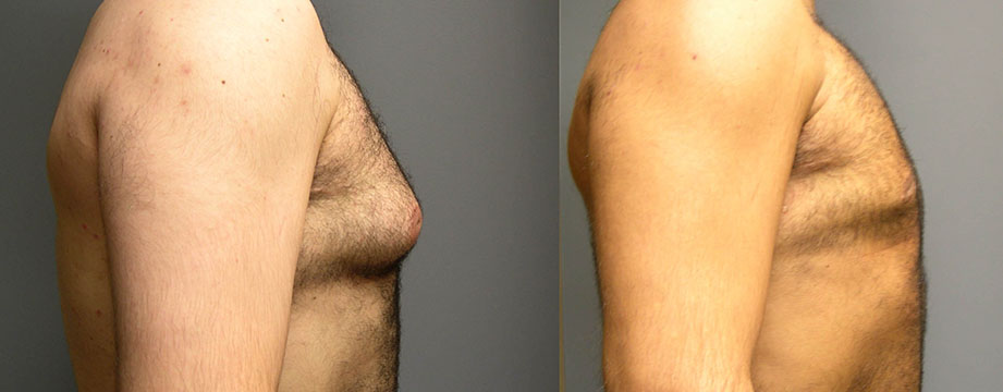 Male Chest Reshaping Journey: Transformational images documenting the results of gynecomastia treatment