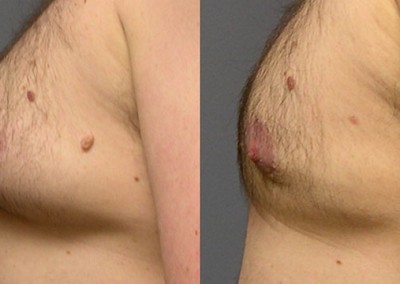 Gynecomastia Surgery Before and After: Comparative photos showing the improvement in chest symmetry