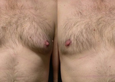 Male Breast Reduction Outcome: Visual evidence of the successful treatment of gynecomastia