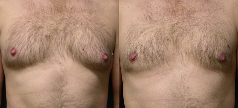 Male Breast Reduction Outcome: Visual evidence of the successful treatment of gynecomastia