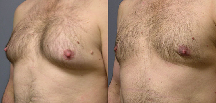 Masculine Chest Enhancement: Before-and-after images displaying the enhancement of male chest appearance